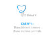 Cas n1 - blanchiment interne dentiste colombes