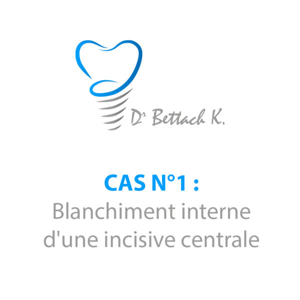 Cas n1 - blanchiment interne dentiste colombes