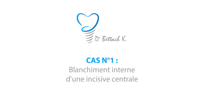 Cas n1 – blanchiment interne dentiste colombes Cas n1 - blanchiment interne dentiste colombes