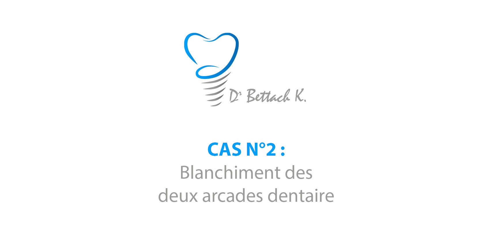 Blanchiment des deux arcades dentaire dentiste colombes