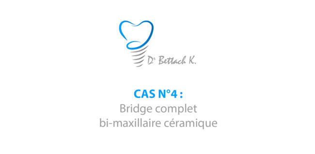 Healthy teeth patient at dentist office Bridge complet bi-maxillaire céramique