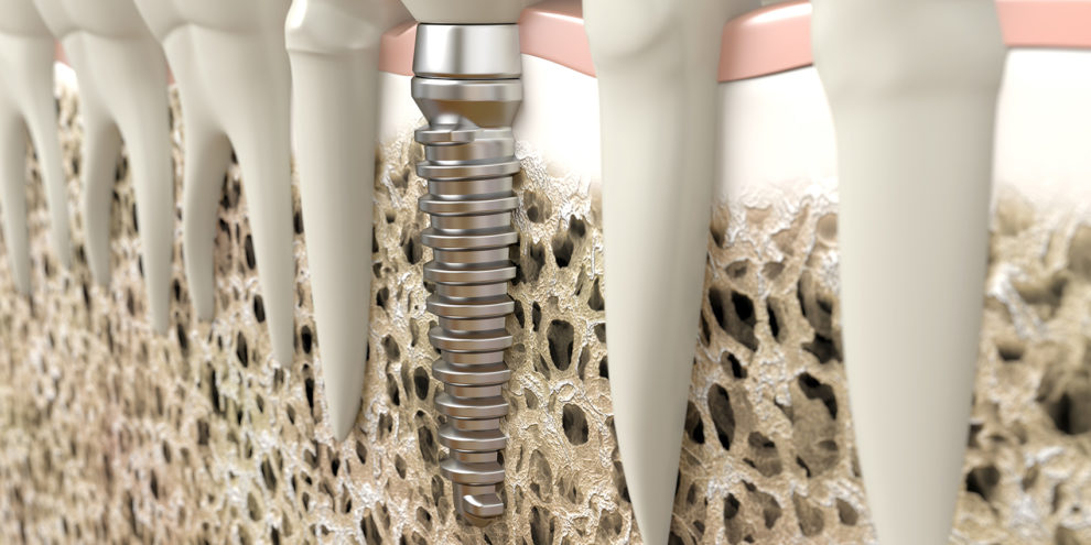 Sinus lift dentiste colombes cabinet dentaire colombes