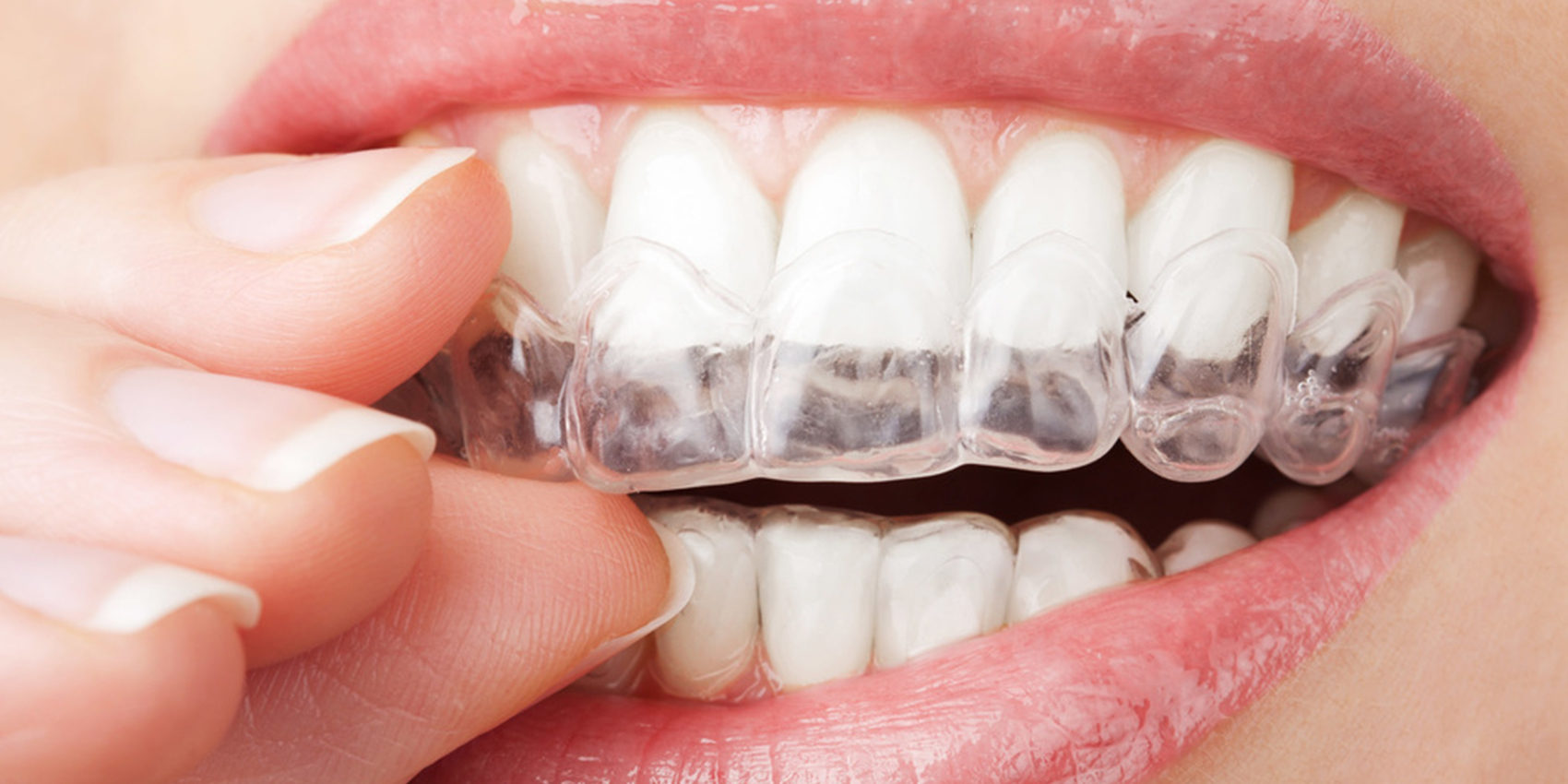 bruxisme dentiste colombes 92700