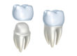 couronnes dentiste colombes dentiste 92
