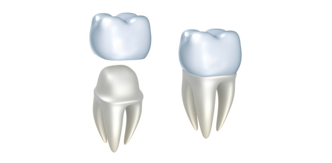 couronnes dentiste colombes dentiste 92 couronnes dentiste colombes dentiste 92