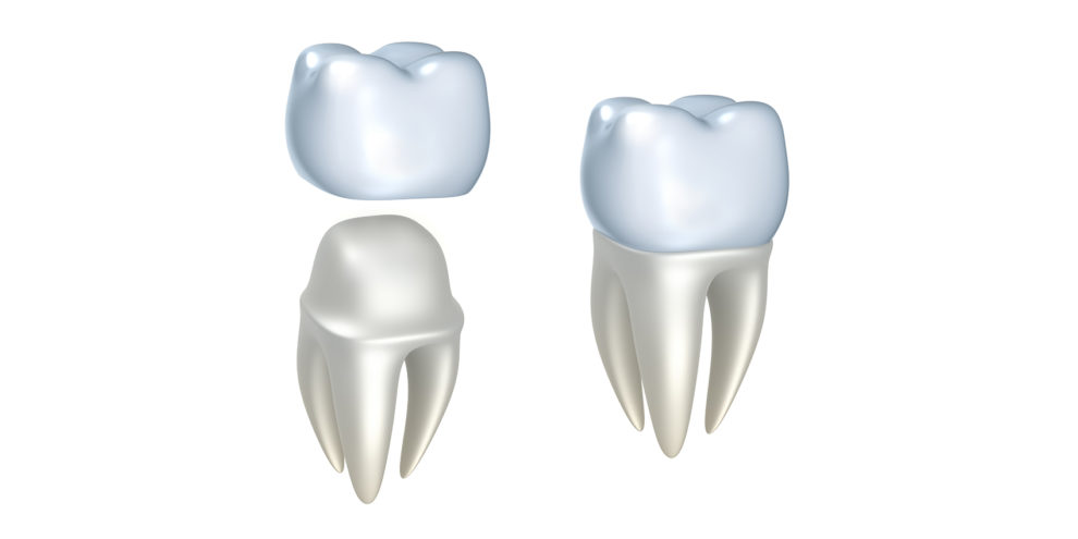 couronnes dentiste colombes dentiste 92