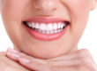 facettes dentiste colombes