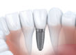 implant dentiste colombes 92