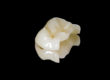 inlay onlay dentiste colombes 92