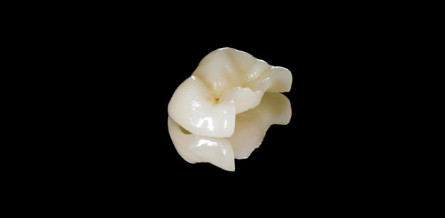 inlay onlay dentiste colombes 92 inlay onlay dentiste colombes 92