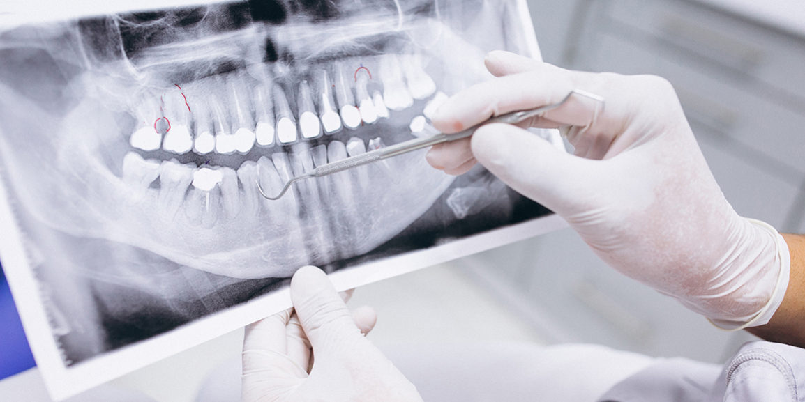 Greffe osseuse dentiste colombes