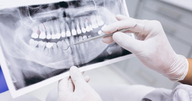 Greffe osseuse dentiste colombes